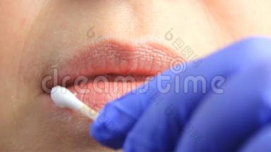 戴手套的医生在患疱疹、疱疹的女孩的嘴唇上涂上棉签。 唇部治疗，慢动作